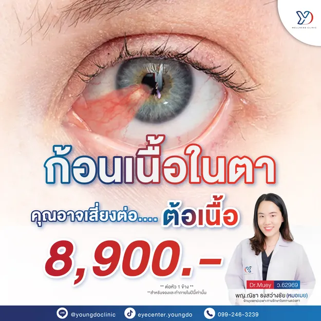 โปรโมชั่นก้อนเนื้อในตา