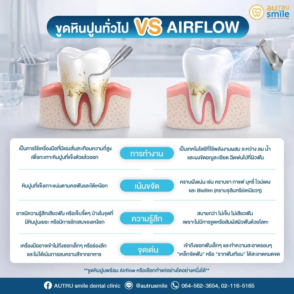 เปรียบเทียบการขูดหินปูนทั่วไป กับระบบ Airflow