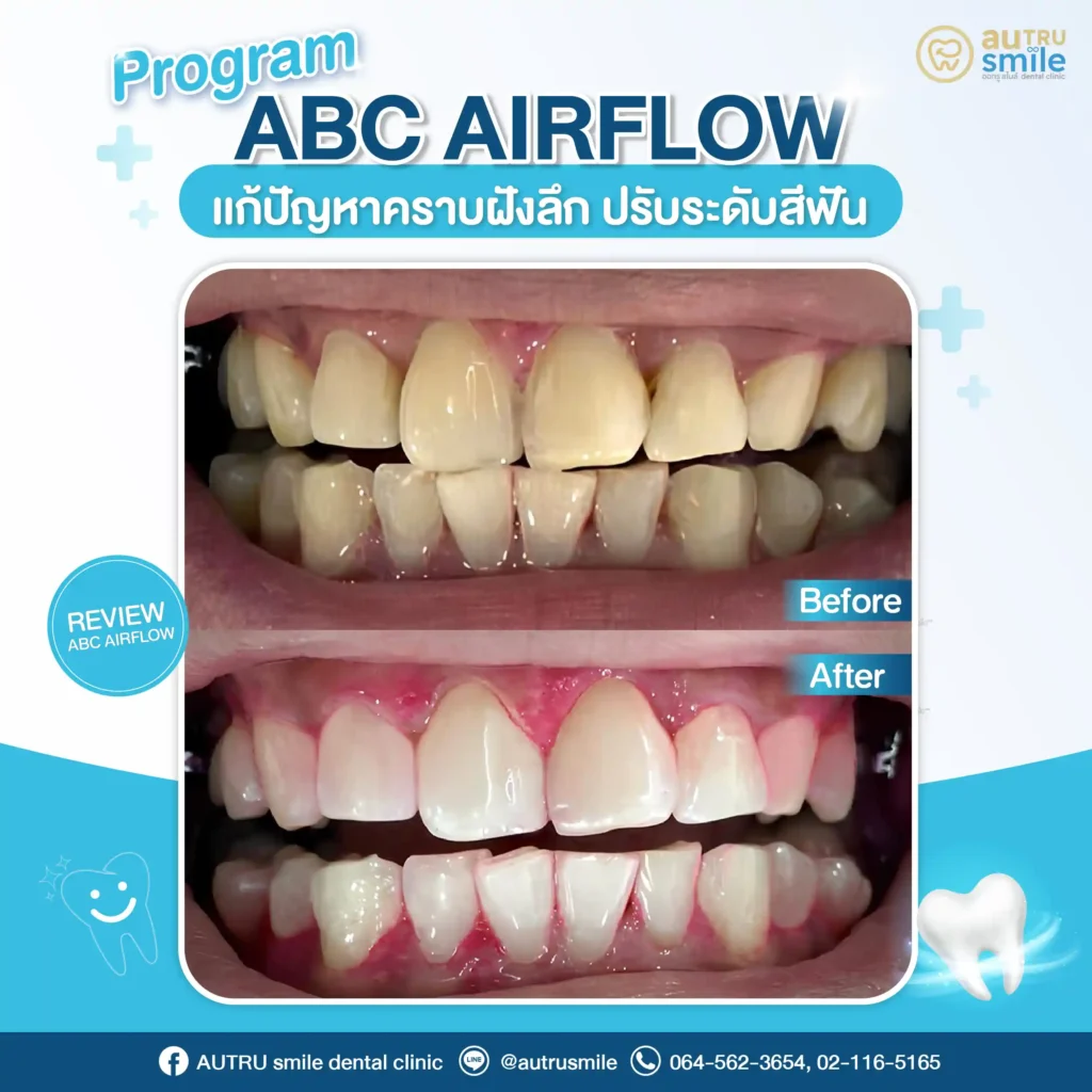 โปรแกรม ABC Airflow (Before/After)