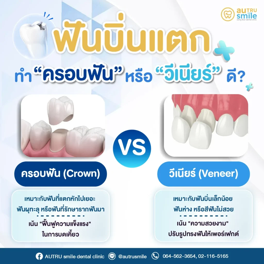 ฟันบิ่นแตก ครอบฟัน vs วีเนียร์