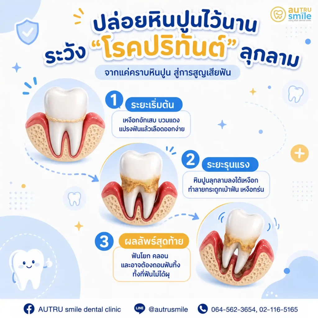 การลุกลามของโรคปริทันต์