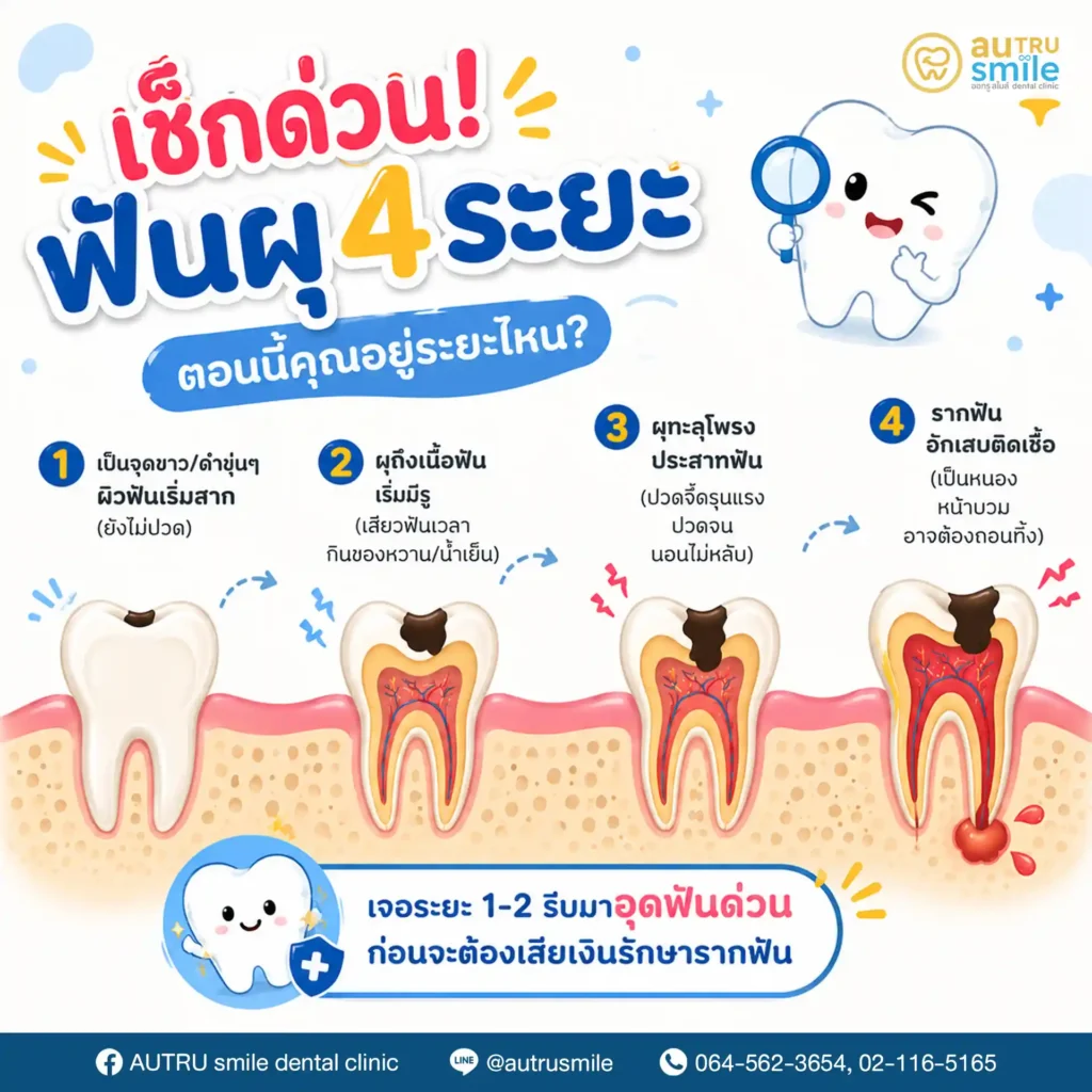 เช็กฟันผุ 4 ระยะ